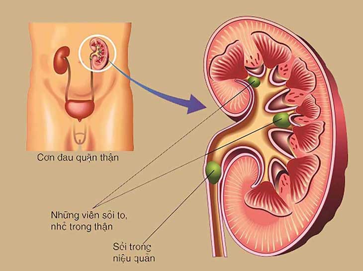 Hình ảnh minh họa sỏi tiết niệu