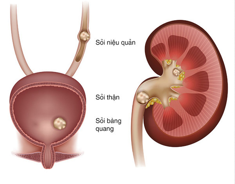 Hình ảnh sỏi niệu quản