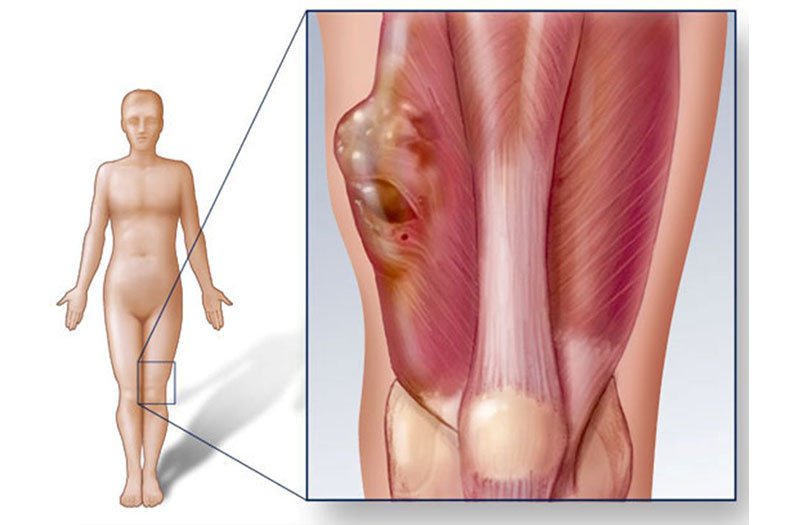Sarcoma là một loại ung thư xuất nguồn từ lớp trung mô ở cơ thể