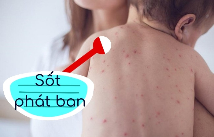 Triệu chứng của sốt phát ban là sốt và nổi ban