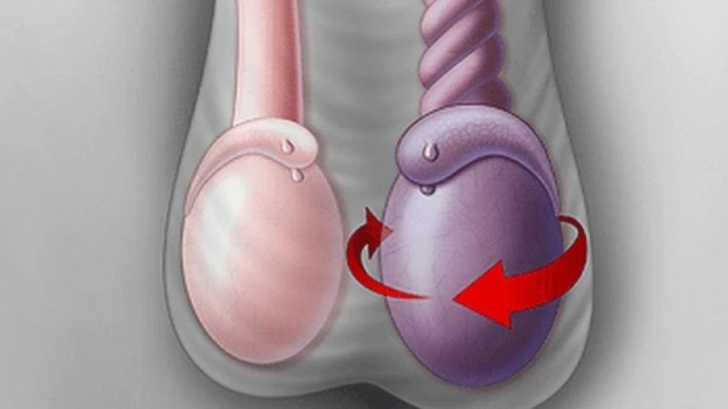 Đau tinh hoàn bên phải có thể kèm theo sưng bìu hoặc khó chịu vùng bẹn