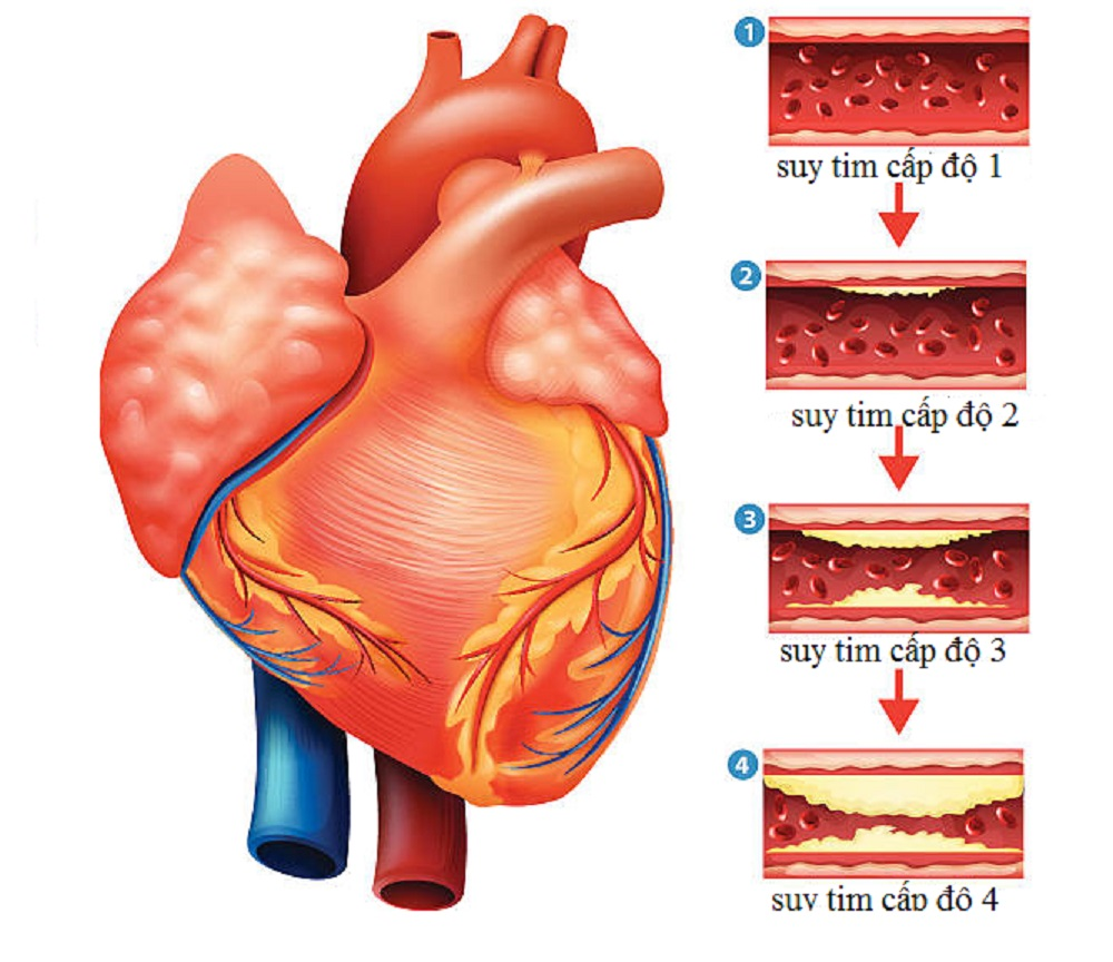 Các cấp độ suy tim 