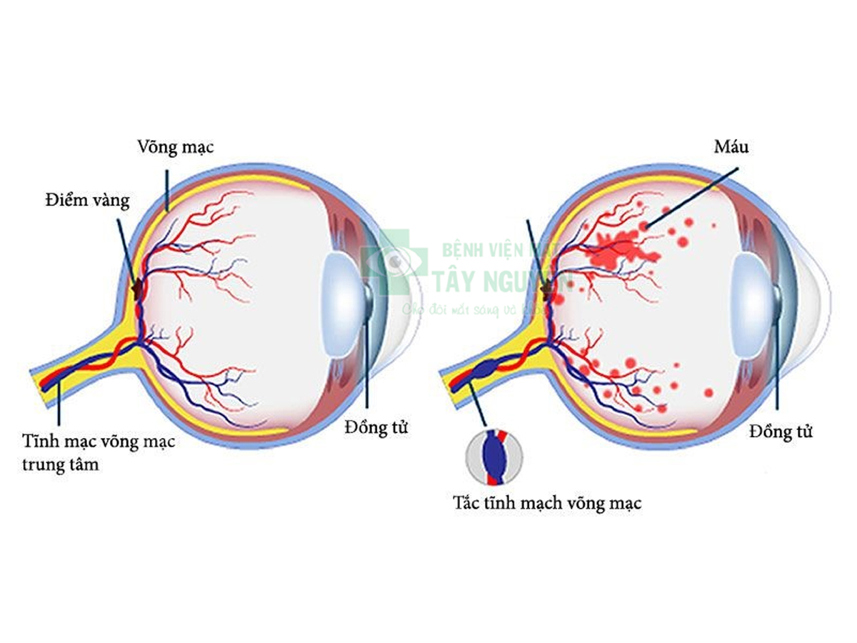 Mắt bị tắc tĩnh mạch võng mạc