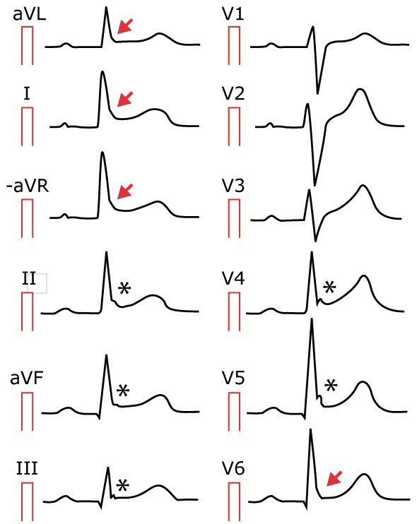 Tái cực sớm được chẩn đoán bằng phương pháp điện tâm đồ