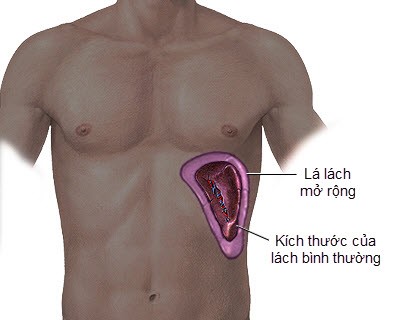 Lách to là triệu chứng phổ biến của tăng áp tĩnh mạch cửa