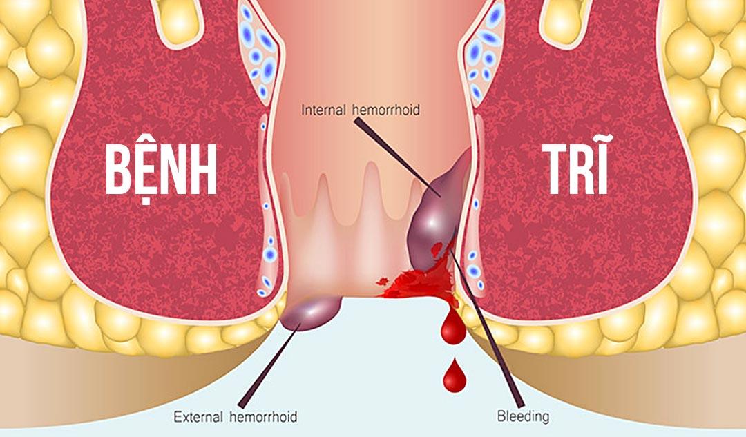 Táo bón gây sưng tĩnh mạch bên trong và xung quanh hậu môn, từ đó gây bệnh trĩ 