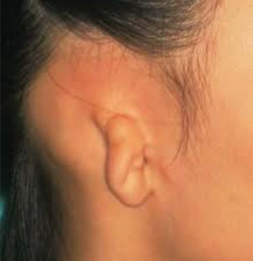 Hình ảnh tật tai nhỏ