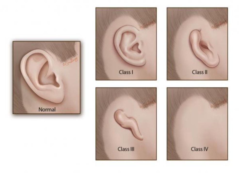 Các cấp độ tật tai nhỏ