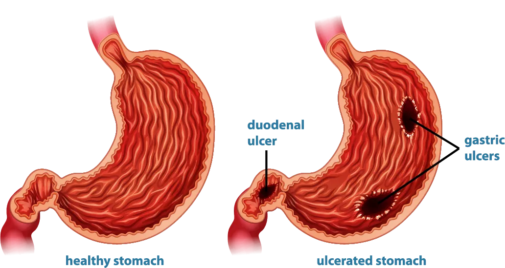 Dạ dày - tá tràng lúc bình thường và khi bị loét