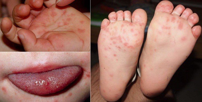 CÁCH CHỮA TAY CHÂN MIỆNG NHANH KHỎI VỚI CHẾ ĐỘ DINH DƯỠNG VÀ VỆ SINH TỐT