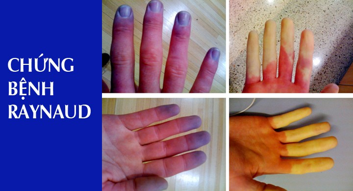 Hình ảnh bàn tay bị bệnh/hội chứng Raynaud