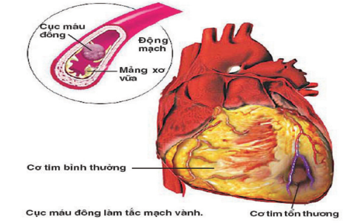 Thiếu máu cục bộ là nguyên nhân phổ biến nhất gây tê tay, tê chân