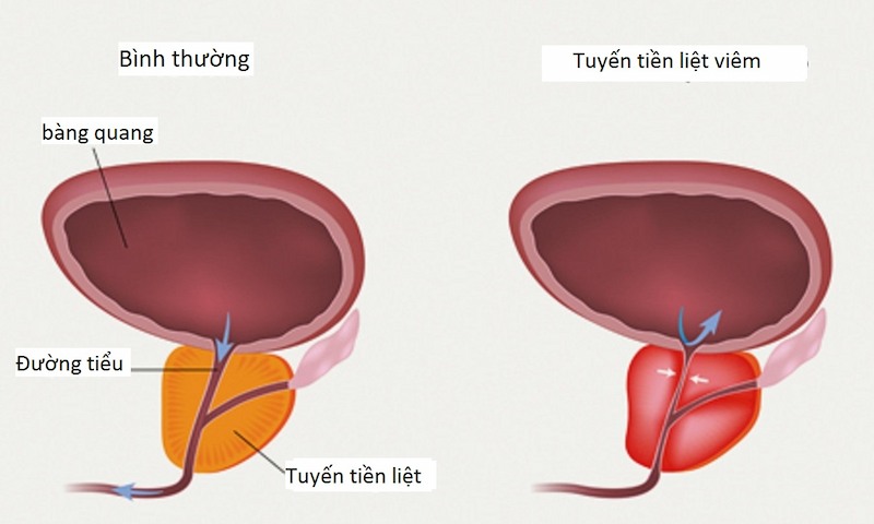 Tắc hậu viêm của ống phóng tinh