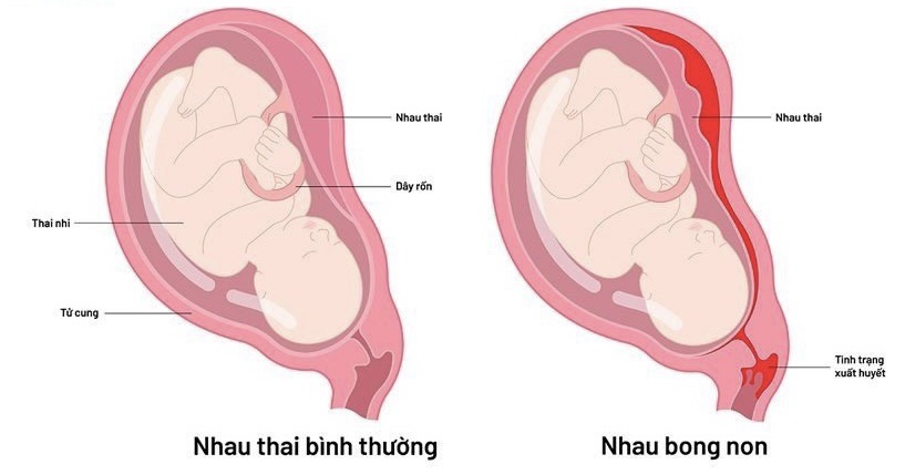 Sự khác biệt giữa dấu hiệu nhau thai thường và nhau bong non dẫn đến thai lưu