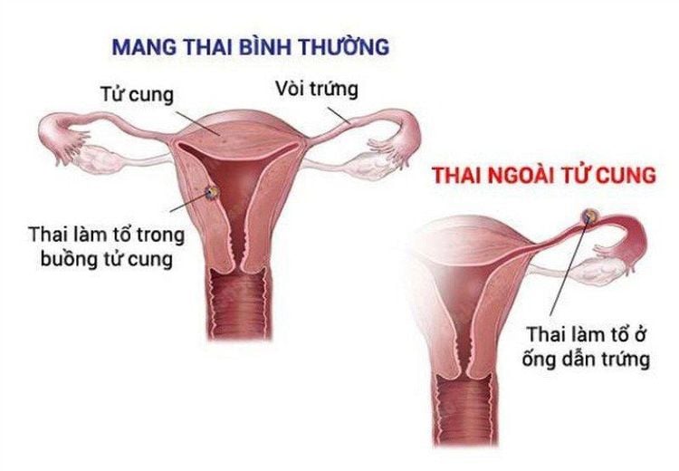 Mang thai ngoài tử cung thường gây ra hiện tượng chảy máu âm đạo bất thường
