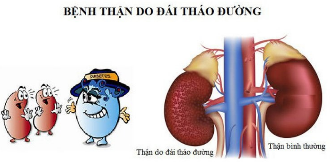 Bệnh thận do tiểu đường là biến chứng thường gặp ở bệnh nhân tiểu đường