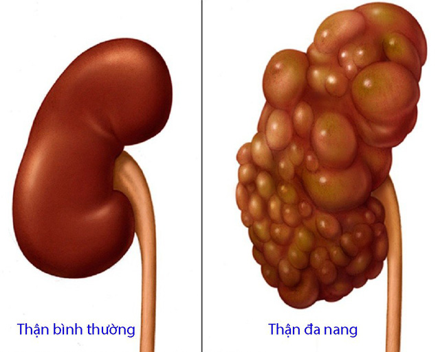 Bệnh thận đa nang và thận bình thường