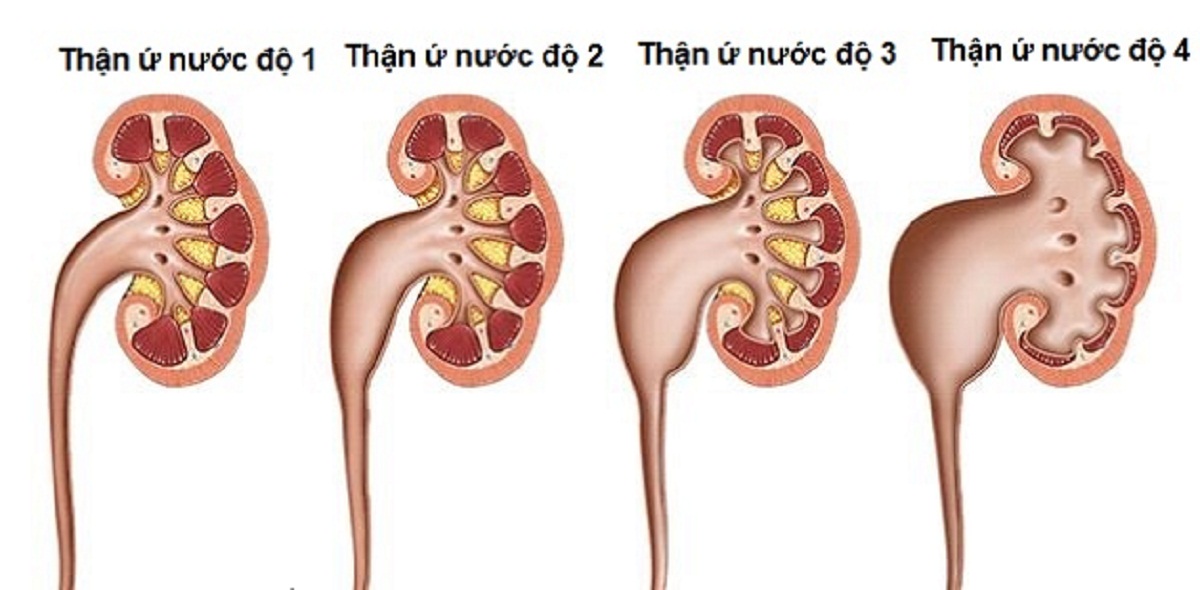 Sự giãn nở của thận do ứ nước