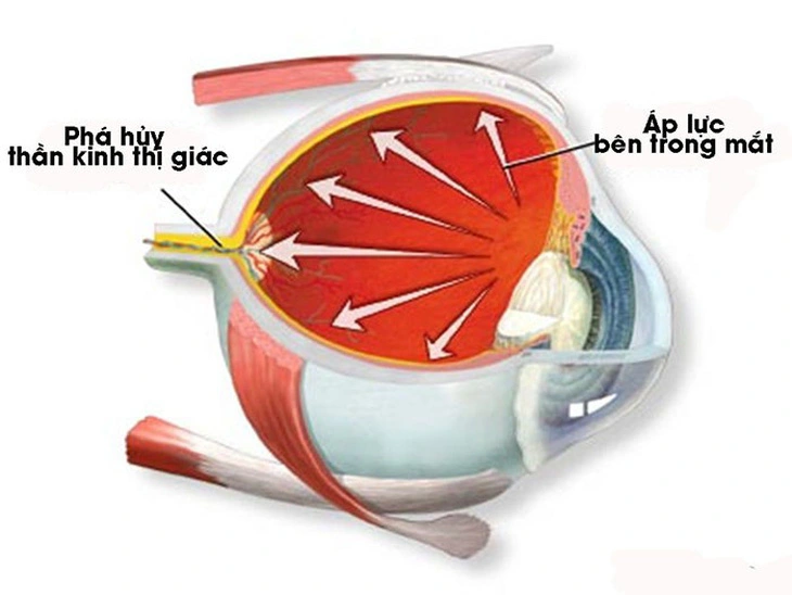 Thiên đầu thống là tình trạng áp lực trong mắt tăng cao khiến dây thần kinh thị giác bị tổn thương