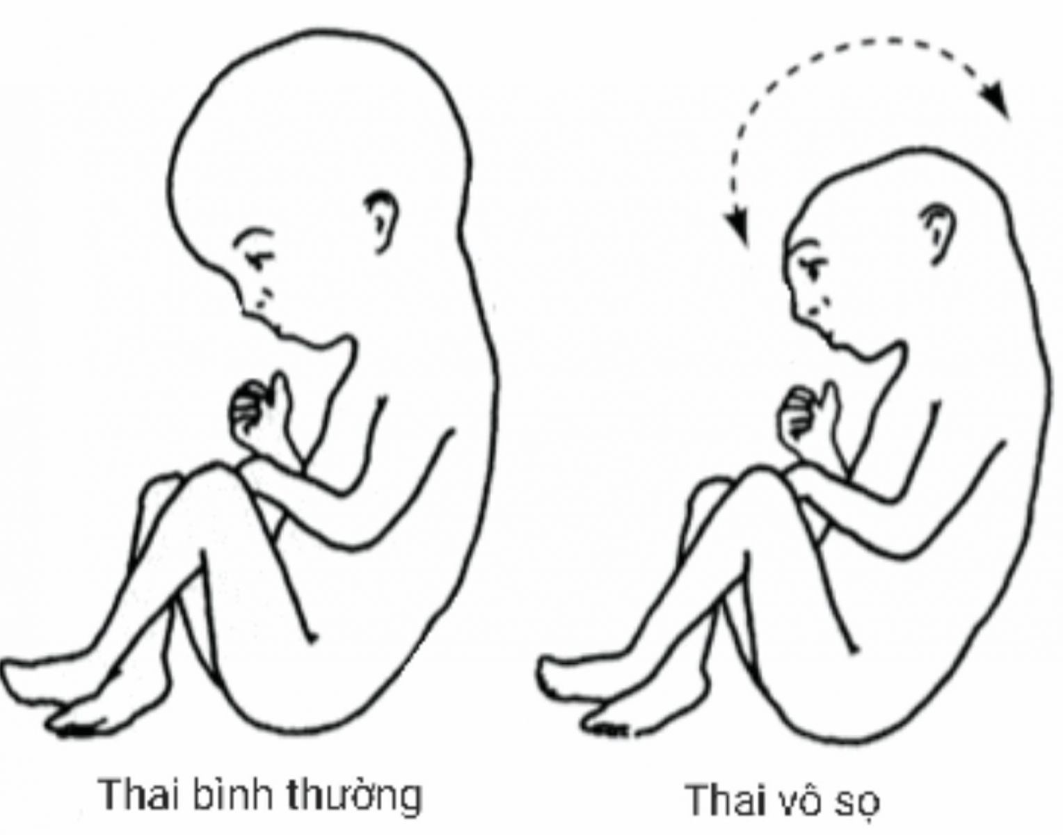 Thiếu 1 phần não hay còn được biết đến là thai vô sọ (Anencephaly)