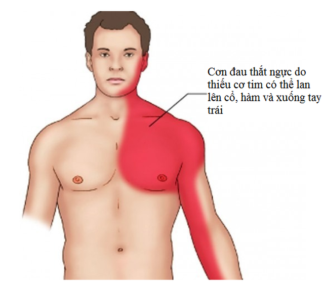 Cần nhận diện triệu chứng của thiếu máu cơ tim cấp tính.