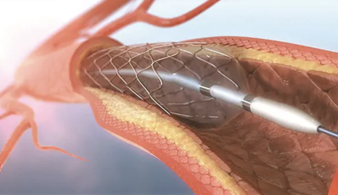 Đặt stent giúp thông tắc mạch máu hiệu quả