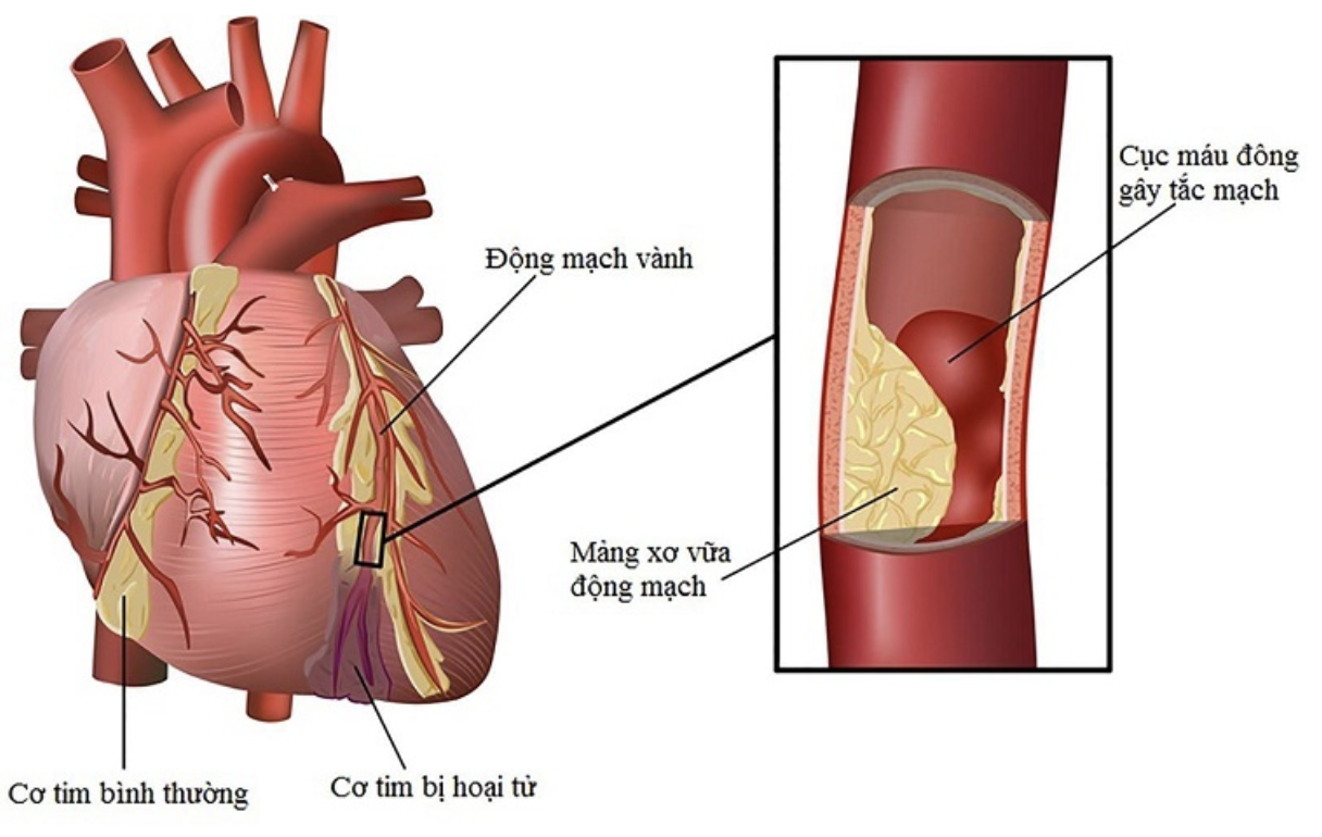 Thiếu máu cơ tim có nguyên nhân từ các mảng xơ vữa, cục máu đông gây tắc mạch