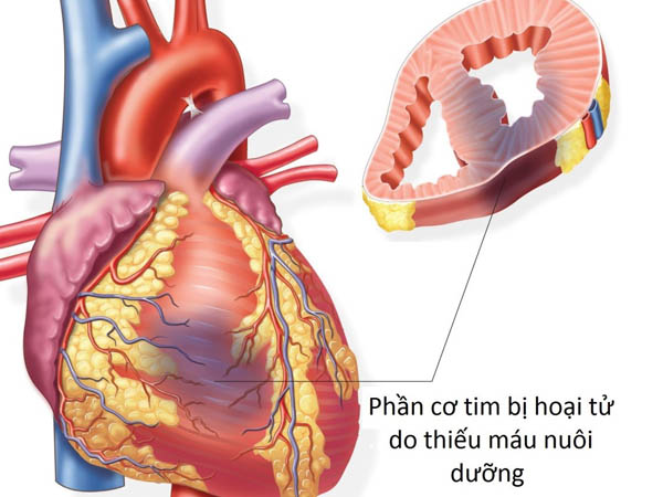 Cơ tim bị hoại tử.