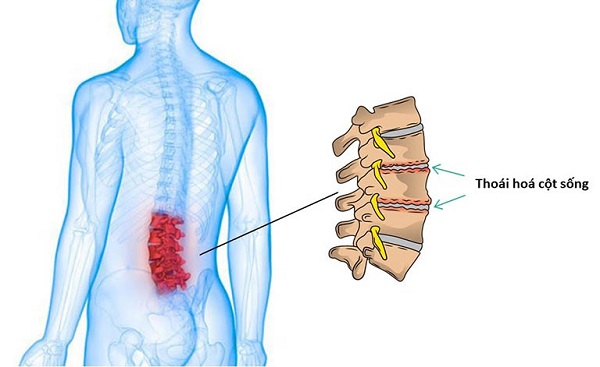 Thoái hóa cột sống