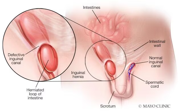 Thoát vị bẹn là một tình trạng phổ biến ở nam giới