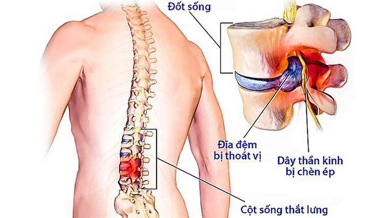 Thoát vị đĩa đệm ở người trẻ tuổi.