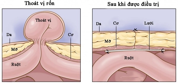 Hình ảnh trước và sau khi điều trị thoát vị rốn