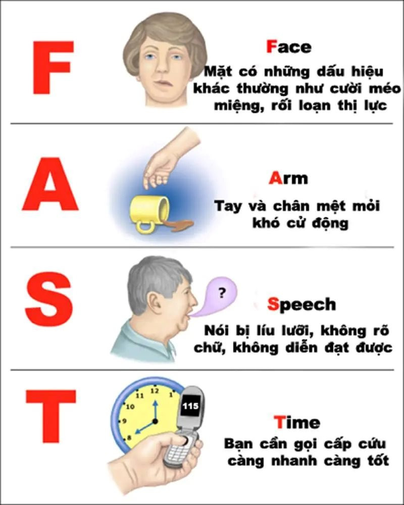 Dấu hiệu FAST trong đột quỵ