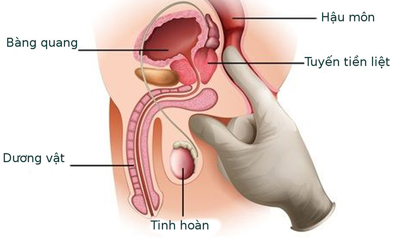 Các phương pháp điều trị ung thư tuyến tiền liệt phụ thuộc vào giai đoạn và mức độ nghiêm trọng của bệnh