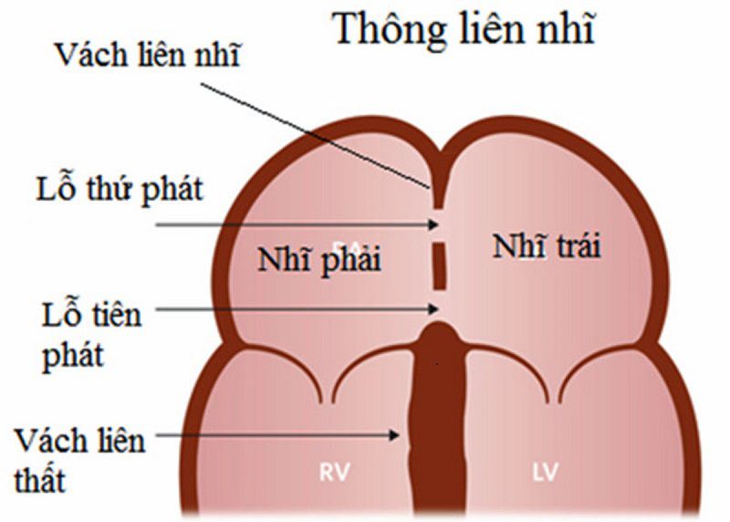 Thông liên nhĩ