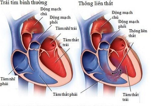 Thông liên thất bẩm sinh