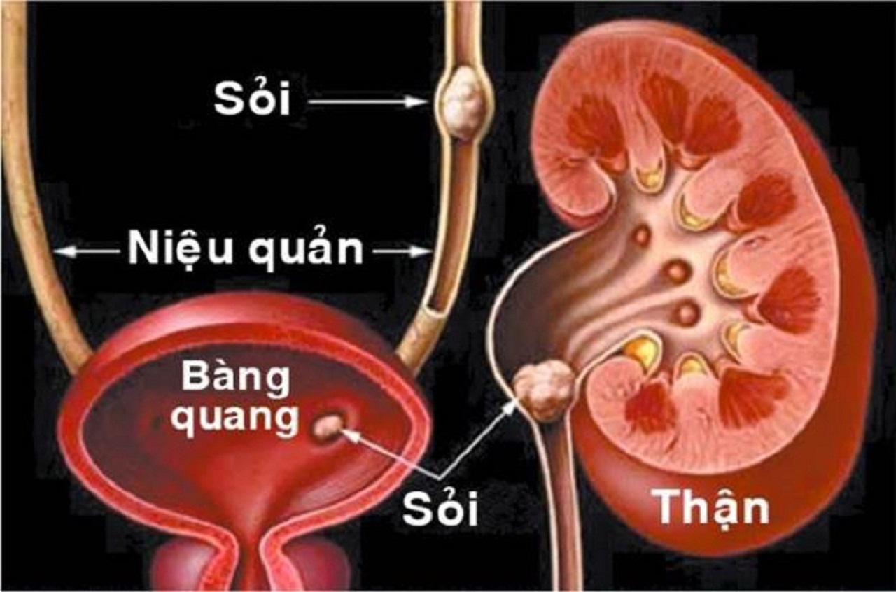 Sỏi tiết niệu