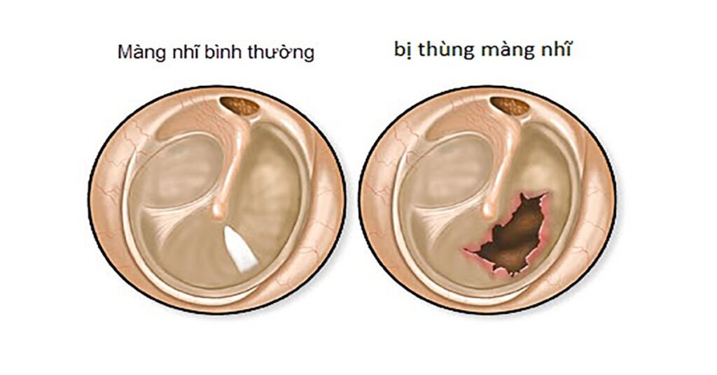 Thủng màng nhĩ là gì?