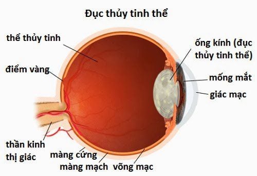 Đục thủy tinh thể