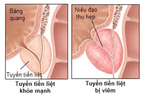 Viêm tuyến tiền liệt là tình trạng viêm nhiễm ở tuyến tiền liệt