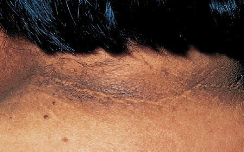 Bệnh gai đen là dấu hiệu nhận biết người mắc bệnh tiểu đường