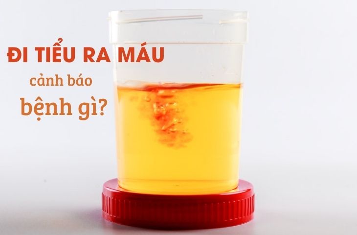 Đái máu là bệnh gì