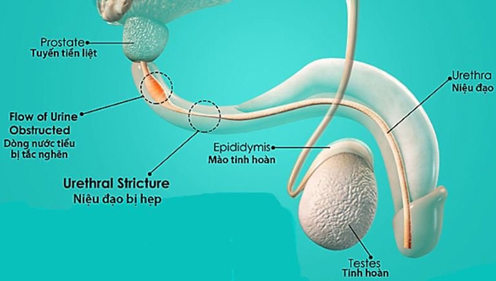 Niệu đạo mới có thể bị hẹp sau phẫu thuật lỗ tiểu lệch thấp