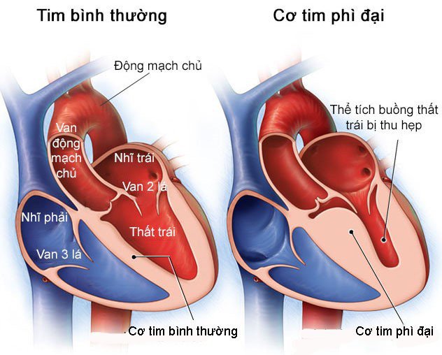 Bệnh cơ tim phì đại giai đoạn tiền triệu chứng được phát hiện qua siêu âm tim khi thấy sự dày lên của cơ tim