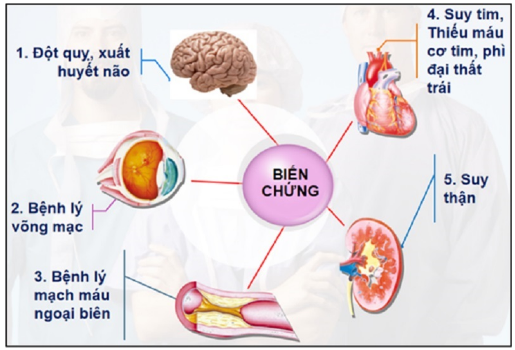 Tăng huyết áp gây nhiều biến chứng nguy hiểm