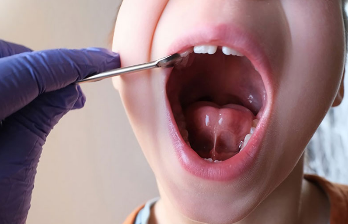 Cắt thắng lưỡi ở trẻ là phương pháp điều trị thường được chỉ định
