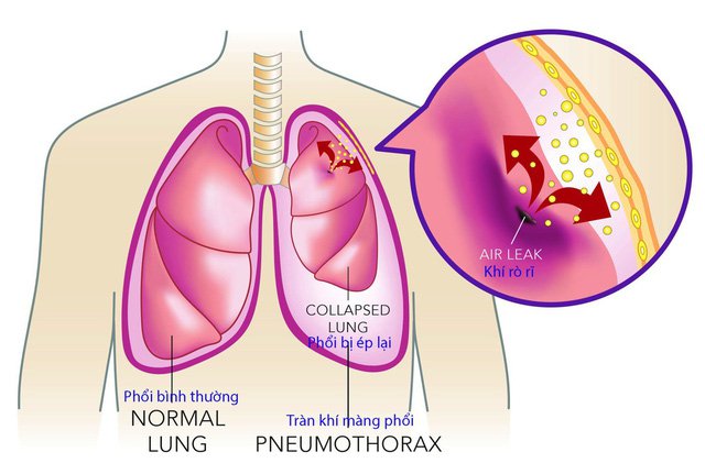 Tràn dịch màng phổi là gì?