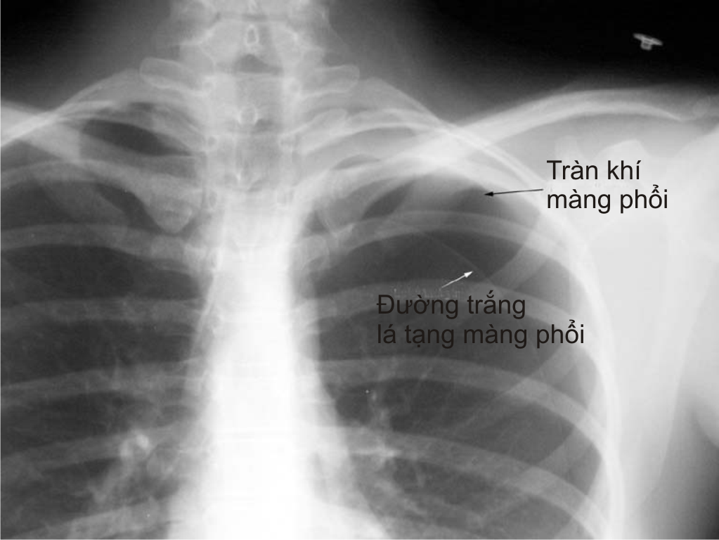 Hình ảnh X- quang tràn khí màng phổi