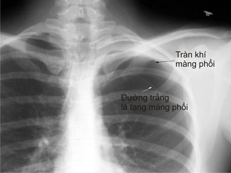 Có thể chẩn đoán tràn khí màng phổi bằng phương pháp chụp X quang