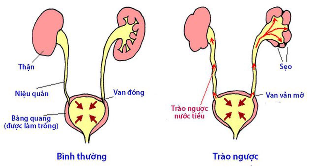 Bệnh trào ngược bàng quang niệu quản